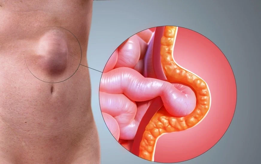 Hérnias abdominais - Dra. Aglaupe Pereira